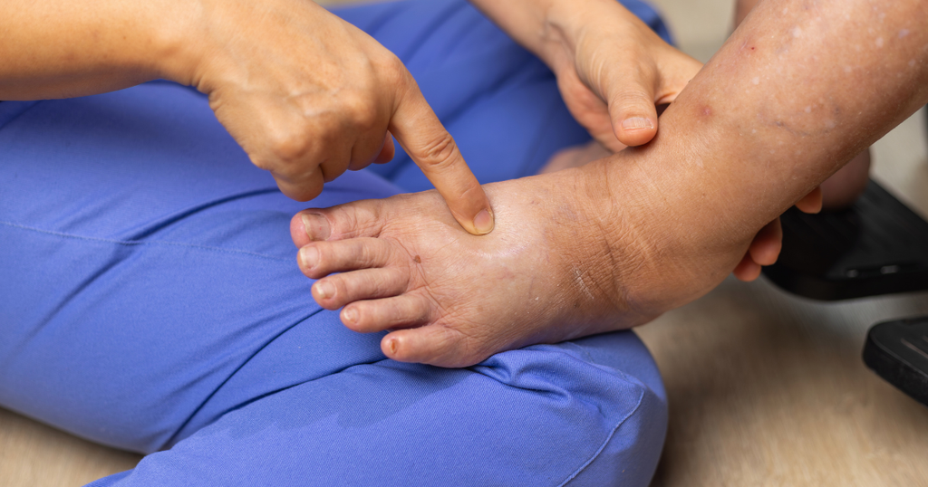 Diabetično stopalo: Kako se zaščititi pred zapleti sladkorne bolezni