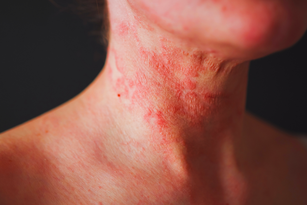 Življenje po kortikosteroidih: Kako obvladati TSW in koži povrniti izgubljeni mir?