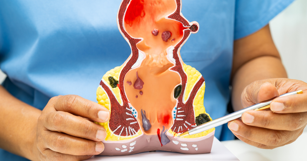 Ali ste vedeli, da se hemoroidi lahko po operaciji ponovijo pri kar 50 % bolnikov?