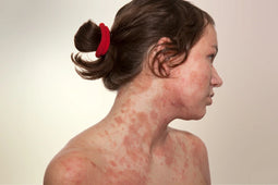 Ekcem in atopijski dermatitis: Zakaj je smiselno poseči po dermonutraceutiku?